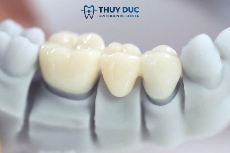 2. Bọc răng sứ có bền không? 1