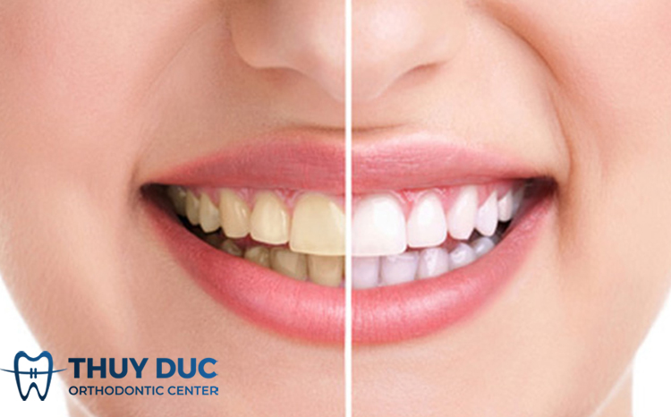 Bọc răng sứ có tẩy trắng được không? 1 Bọc răng sứ có tẩy trắng được không? 1