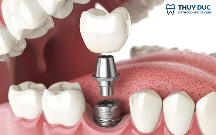 Lưu ý gì trước khi trồng răng Implant? 1