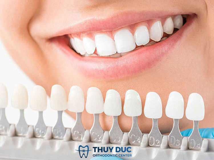 1. Bọc răng sứ là gì? 1