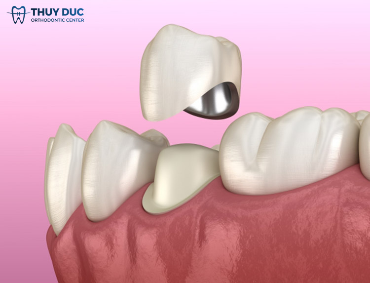 2. Bọc răng sứ là gì? 1 2. Bọc răng sứ là gì? 1