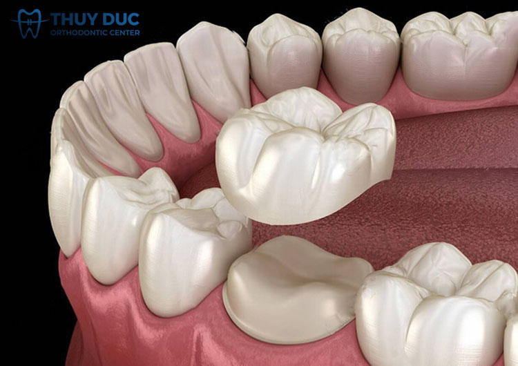 1. Bọc răng sứ là gì? 1 1. Bọc răng sứ là gì? 1