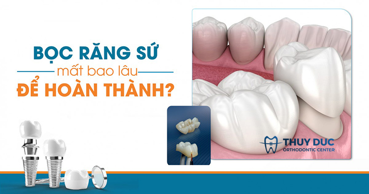 Bọc răng sứ mất thời gian bao lâu? 1 Bọc răng sứ mất thời gian bao lâu? 1