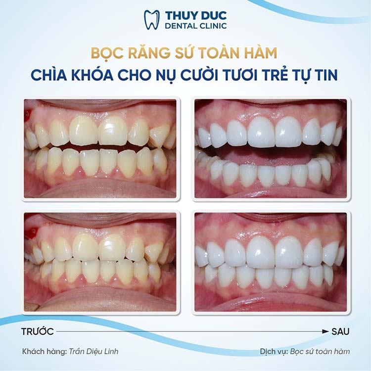 Quy trình bọc răng sứ chuẩn Y khoa 2 Quy trình bọc răng sứ chuẩn Y khoa 2