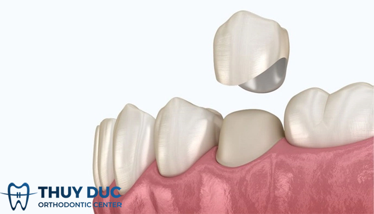 Trường hợp nào nên bọc răng sứ cho răng sâu? 1 Trường hợp nào nên bọc răng sứ cho răng sâu? 1