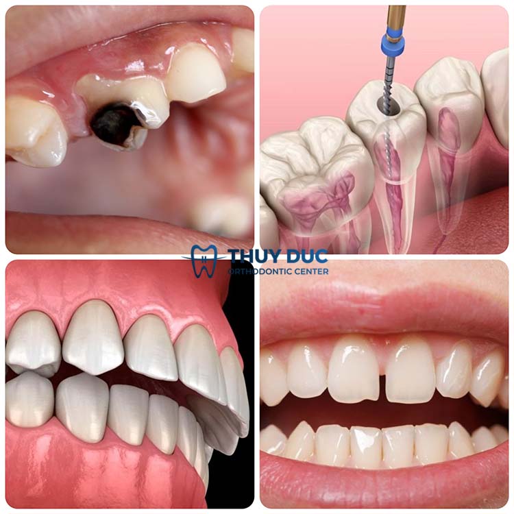 4. Răng sứ Emax phù hợp trong trường hợp nào? 1 4. Răng sứ Emax phù hợp trong trường hợp nào? 1