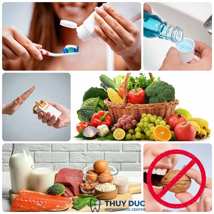 8. Chăm sóc răng miệng sau khi bọc răng sứ nguyên hàm như thế nào? 1 8. Chăm sóc răng miệng sau khi bọc răng sứ nguyên hàm như thế nào? 1