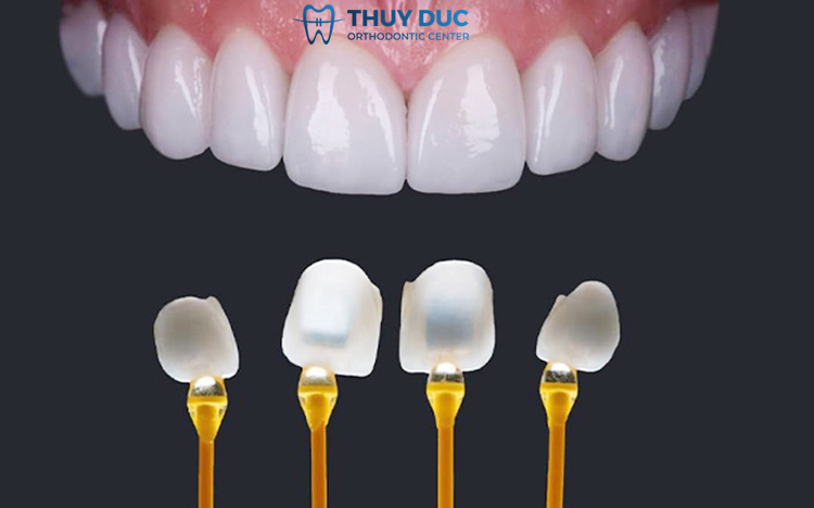 1. Dán răng sứ Veneer là gì? 1 1. Dán răng sứ Veneer là gì? 1