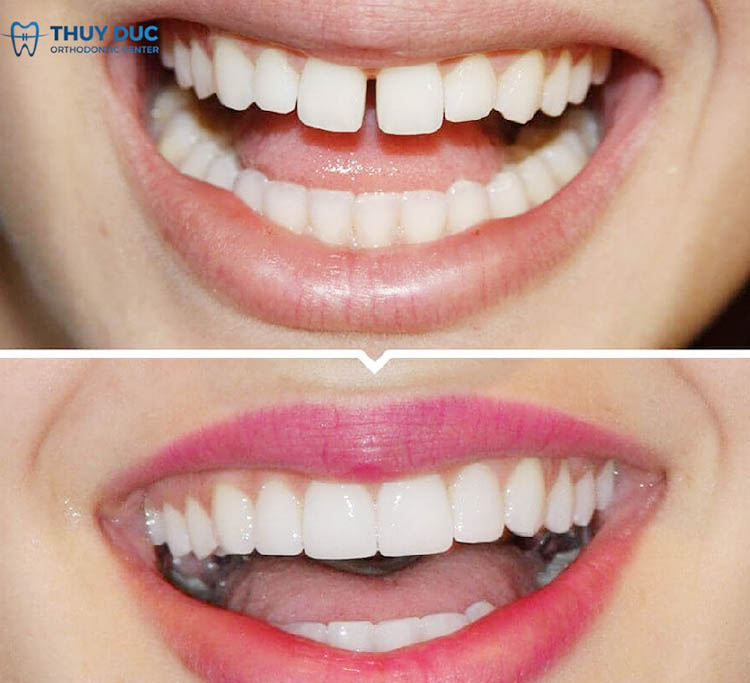 4. Hình ảnh trước và sau bọc răng sứ 1 4. Hình ảnh trước và sau bọc răng sứ 1
