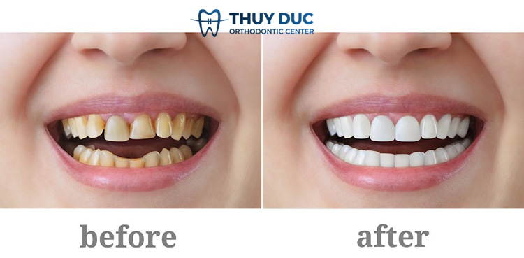 4. Hình ảnh trước và sau bọc răng sứ 3 4. Hình ảnh trước và sau bọc răng sứ 3