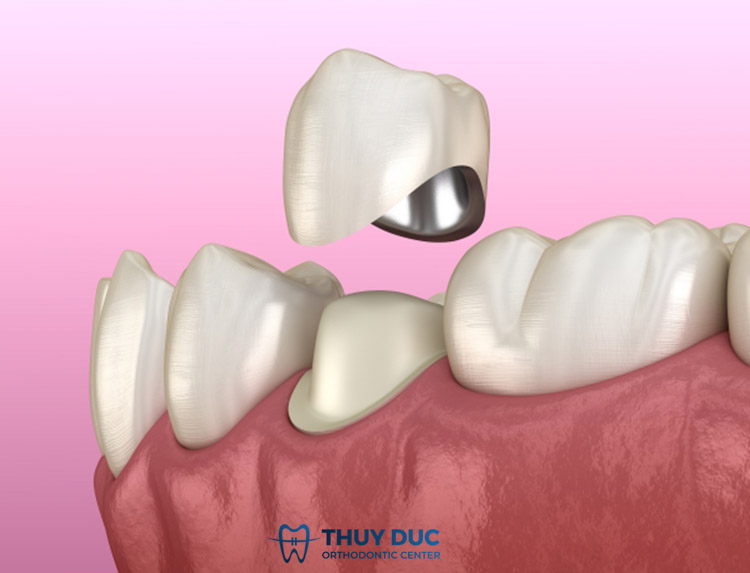 Các trường hợp cần mài răng 2 Các trường hợp cần mài răng 2