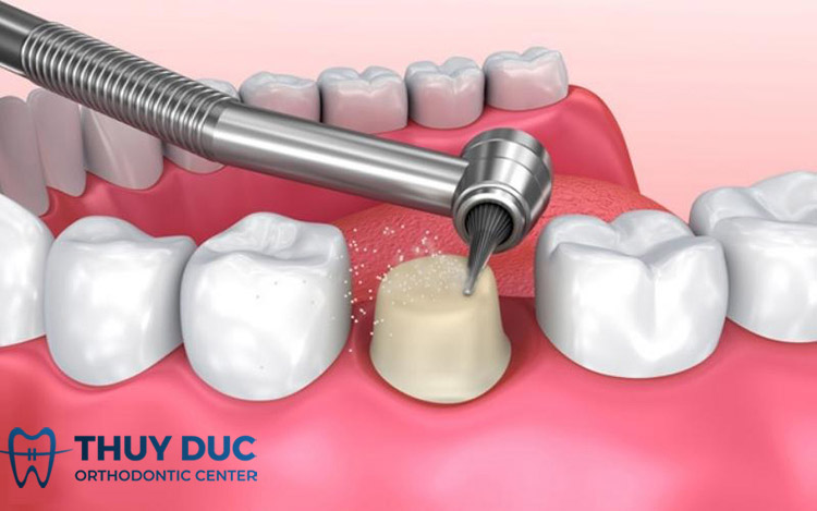 Nguyên tắc khi mài răng bọc sứ 1 Nguyên tắc khi mài răng bọc sứ 1