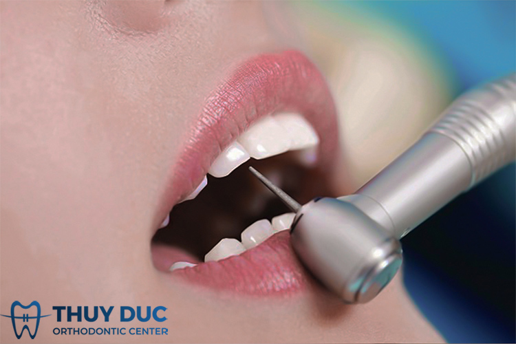 Gây tê và mài cùi 2 răng cửa 1 Gây tê và mài cùi 2 răng cửa 1