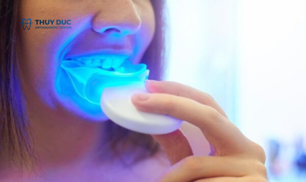 Tẩy trắng răng giữ được bao lâu? 2 Tẩy trắng răng giữ được bao lâu? 2
