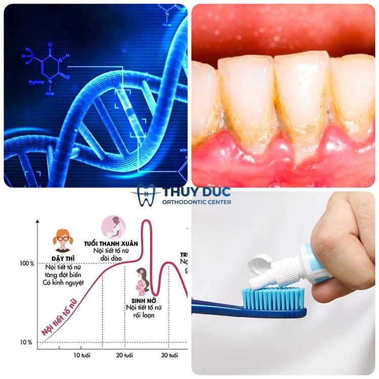 2. Những nguyên nhân gây tình trạng tụt lợi 1