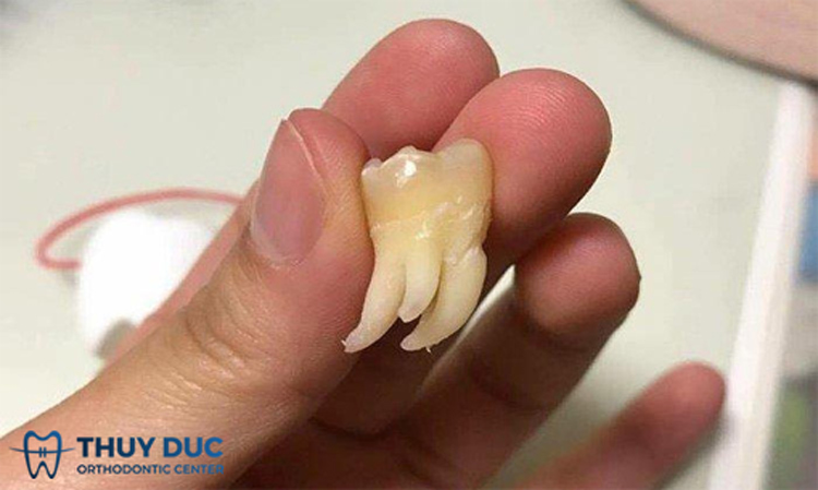 Nên nhổ răng khôn 1 lần mấy cái? 1 Nên nhổ răng khôn 1 lần mấy cái? 1