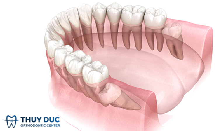 7. Lợi Ích Của Việc Nhổ Răng Khôn Sớm