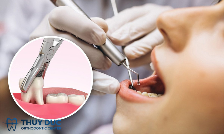 Nhổ răng khôn có đau không? Cách giảm đau khi nhổ răng khôn 1 Nhổ răng khôn có đau không? Cách giảm đau khi nhổ răng khôn 1