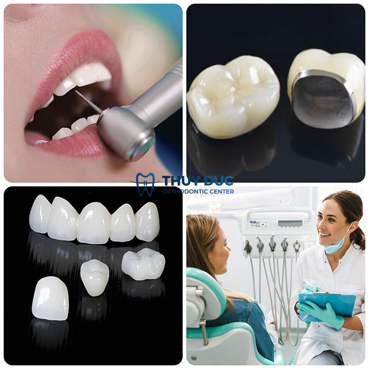 7. Những yếu tố quan trọng cần biết trước khi bọc răng sứ 1 7. Những yếu tố quan trọng cần biết trước khi bọc răng sứ 1