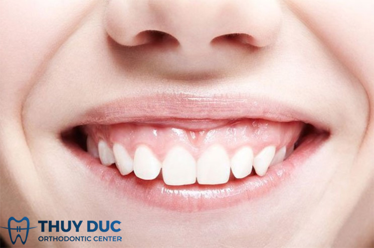 Răng hô là gì? 1