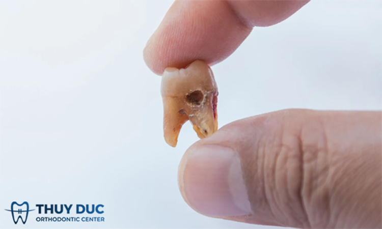 Răng khôn bị sâu nên hàn trám hay nhổ bỏ? 1 Răng khôn bị sâu nên hàn trám hay nhổ bỏ? 1