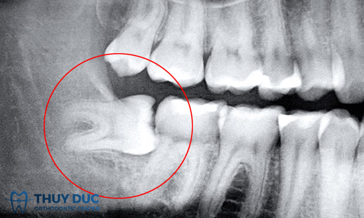 Răng khôn mọc lệch 90 độ gây ảnh hưởng gì? 1 Răng khôn mọc lệch 90 độ gây ảnh hưởng gì? 1