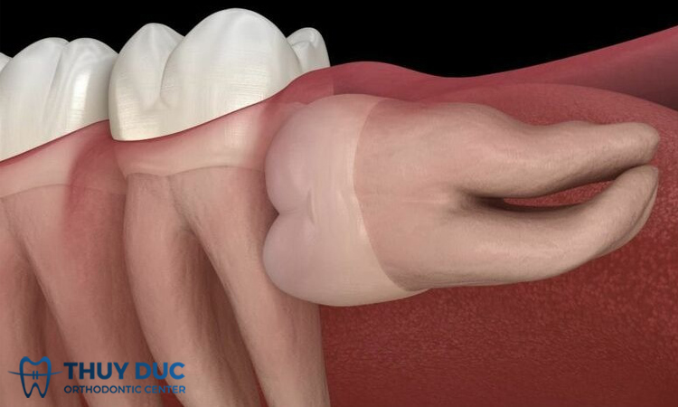 Nhổ răng khôn mọc lệch 90 có khó không? Chi phí hết bao nhiêu? 1 Nhổ răng khôn mọc lệch 90 có khó không? Chi phí hết bao nhiêu? 1