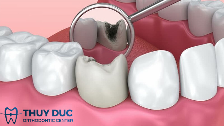 Răng sâu có bọc sứ được không? 1 Răng sâu có bọc sứ được không? 1