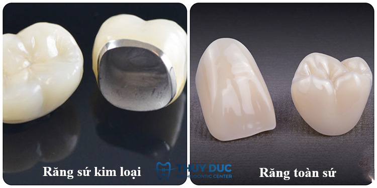 Bọc răng sứ được bao lâu thì phải thay thế? 1