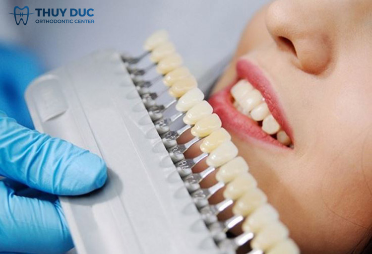 5. Răng xỉn màu nên bọc răng sứ nguyên hàm hay tẩy trắng? 1 5. Răng xỉn màu nên bọc răng sứ nguyên hàm hay tẩy trắng? 1