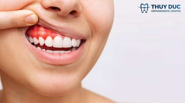 4. Rủi ro khi bọc răng sứ không an toàn 1 4. Rủi ro khi bọc răng sứ không an toàn 1