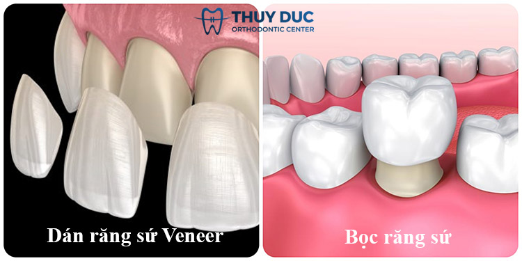 3. So sánh sự khác biệt giữa dán sứ Veneer và bọc sứ 1 3. So sánh sự khác biệt giữa dán sứ Veneer và bọc sứ 1
