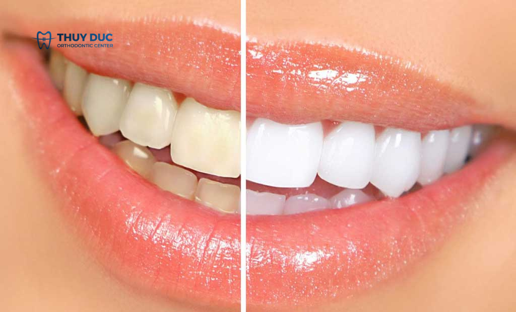 Tẩy trắng răng giữ được bao lâu? 1 Tẩy trắng răng giữ được bao lâu? 1
