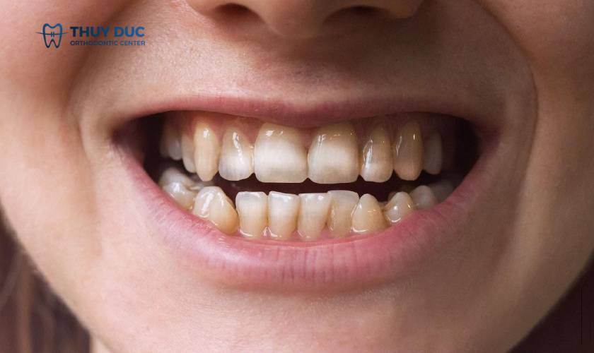 Điều trị thiểu sản men răng như thế nào? 1