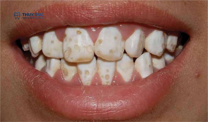 Thiếu sản men răng là bệnh gì? 1