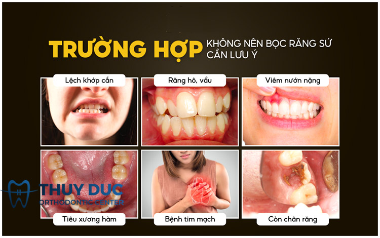 Các trường hợp không nên bọc răng sứ 1