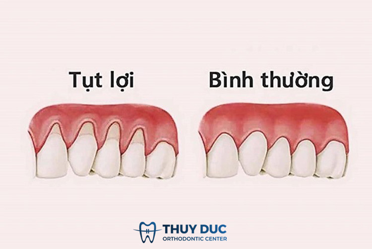 1. Tụt lợi trong nha khoa là gì? 1