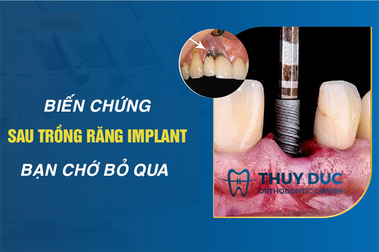 Điểm mặt những biến chứng có thể gặp khi cấy ghép Implant 1 Điểm mặt những biến chứng có thể gặp khi cấy ghép Implant 1
