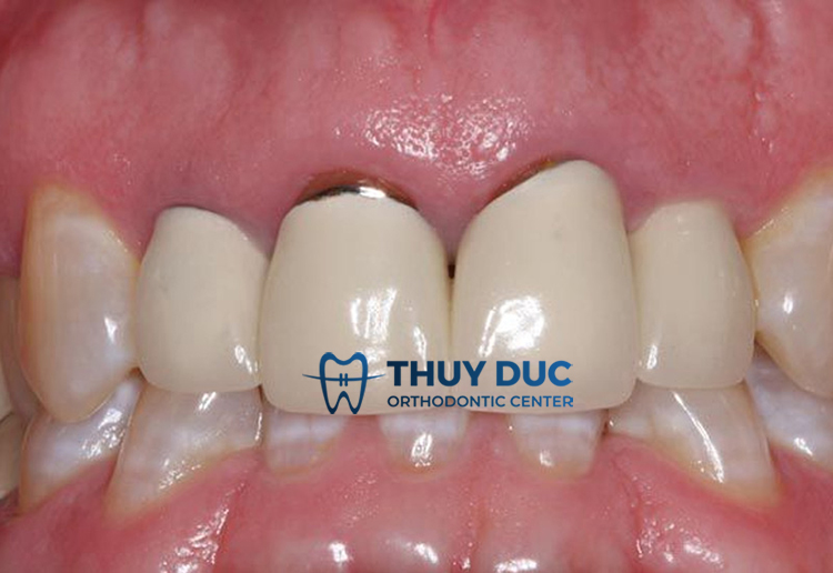 Do chọn chất liệu sứ kim loại 1 Do chọn chất liệu sứ kim loại 1