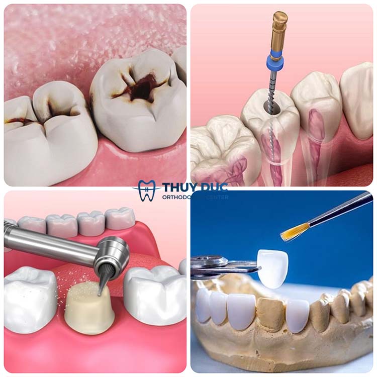 Ưu điểm của phương pháp bọc sứ sau khi lấy tủy răng 1 Ưu điểm của phương pháp bọc sứ sau khi lấy tủy răng 1