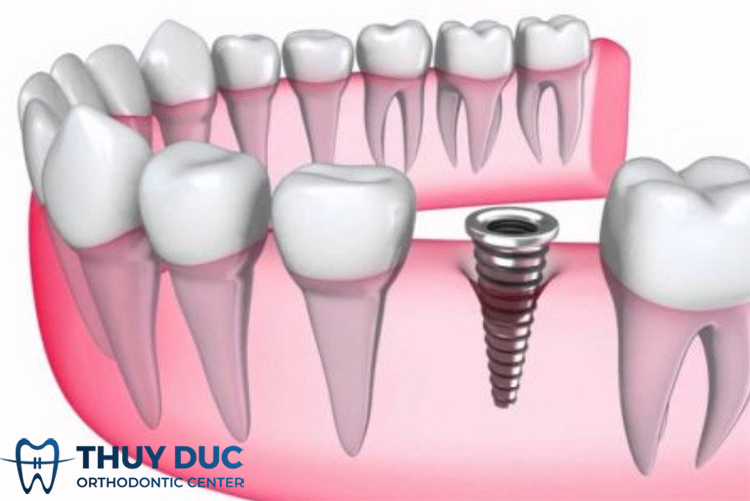 Quy trình cấy ghép implant 1 Quy trình cấy ghép implant 1