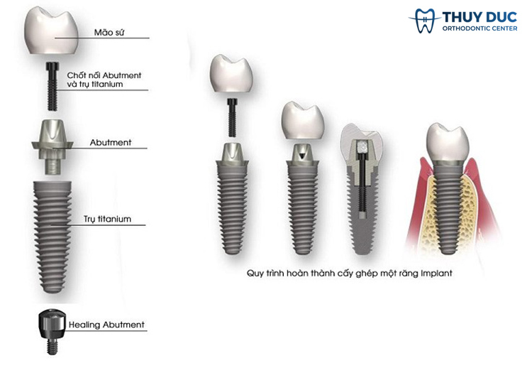 Cấu tạo của trụ implant 1 Cấu tạo của trụ implant 1