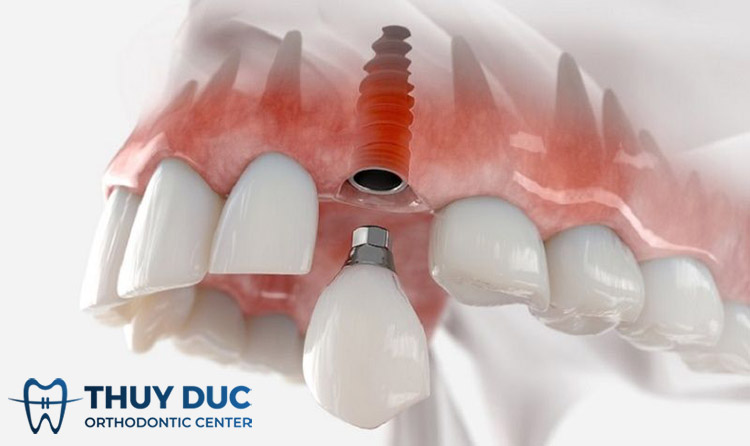Trồng răng Implant mất thời gian bao lâu thì hoàn thiện? 1 Trồng răng Implant mất thời gian bao lâu thì hoàn thiện? 1