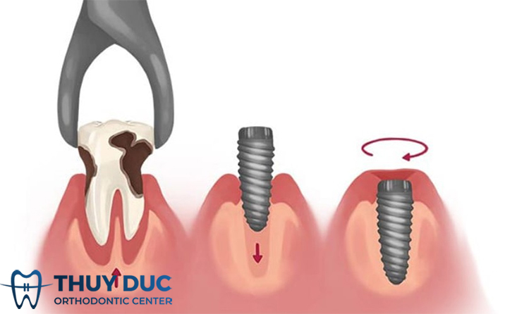 Cấy ghép implant tức thì là gì? 1