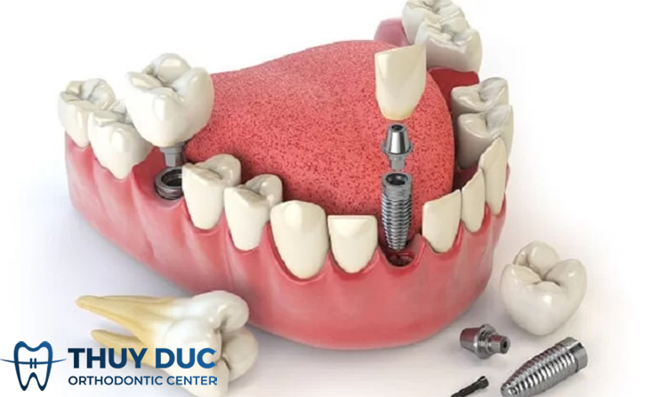 Trường hợp nào nên và không nên cấy implant tức thì? 1