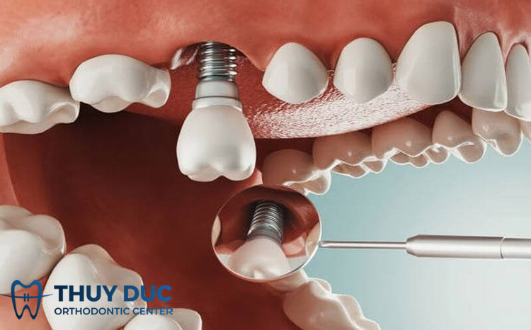 Bước 4: Thực hiện phẫu thuật cấy ghép trụ Implant 1 Bước 4: Thực hiện phẫu thuật cấy ghép trụ Implant 1