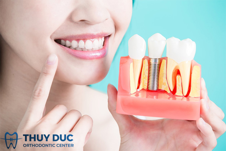 Cấy ghép Implant tức thì có an toàn không? 1