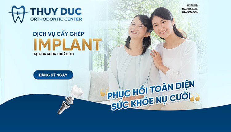 Địa chỉ cấy ghép implant uy tín tại Hà Nội 1 Địa chỉ cấy ghép implant uy tín tại Hà Nội 1