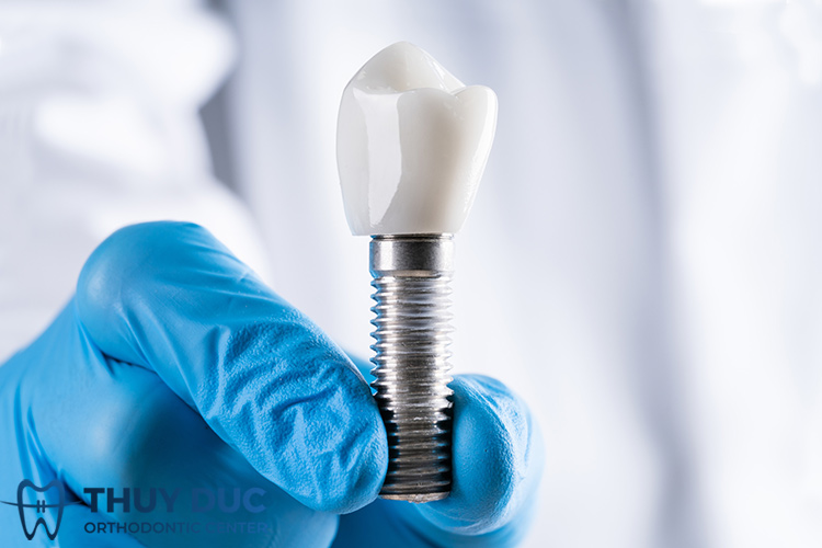Nguyên nhân nào khiến răng implant bị đào thải? 2 Nguyên nhân nào khiến răng implant bị đào thải? 2