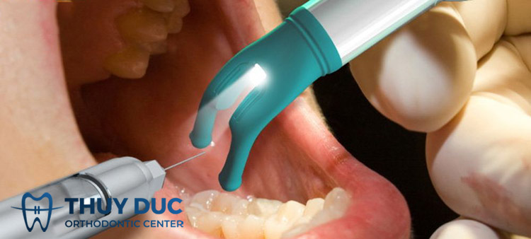 Trồng răng Implant có đau không? 1 Trồng răng Implant có đau không? 1